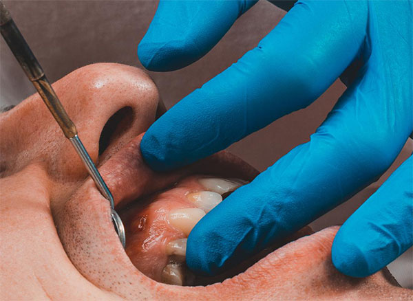 Fístula Dental | Clínica Dental Artdenta Valencia