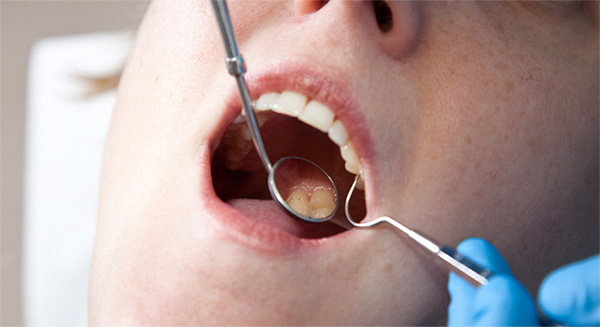 Eliminación Placa Dental | Clínica Dental Artdenta Valencia