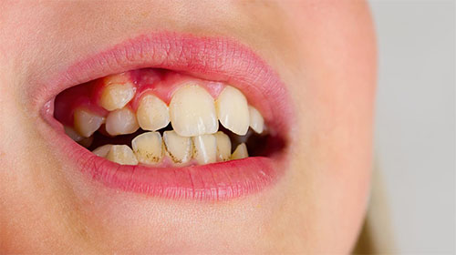 Dientes Apiñados | Clínica Dental Artdenta Valencia