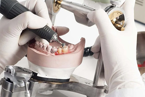 Fabricación Esquelético Dental | Clínica Dental Artdenta Valencia