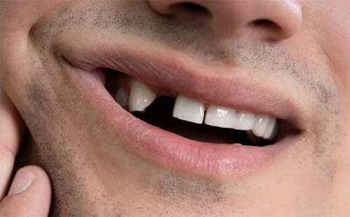 Falta diente Esquelético Dental | Clínica Dental Artdenta Valencia