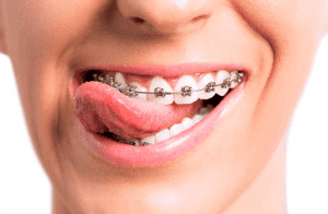 Ortodoncia brackets