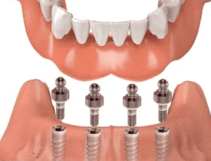 IMPLANTE DENTAL