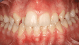 Apiñamiento dental
