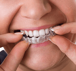 Invisalign