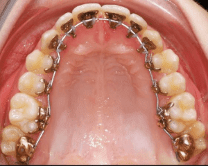 Ortodoncia sublingual