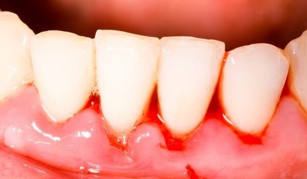 Causas de las encías sangrantes - Clínica Dental en Valencia Benimaclet ARTDENTA