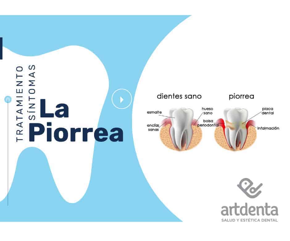 Piorrea, tratamiento, causas | Clínica Dental Artdenta en Valencia
