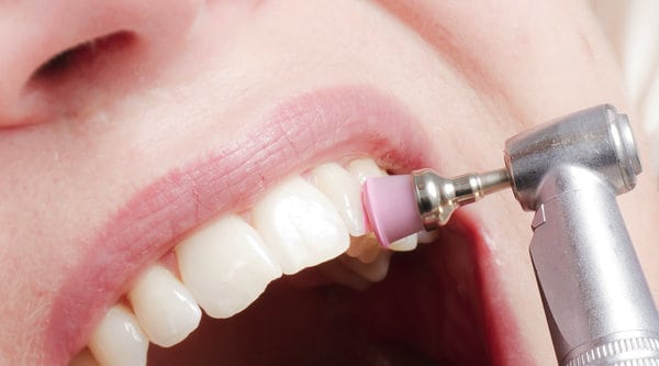 Limpieza dental profesional - Clínica Dental en Valencia Benimaclet