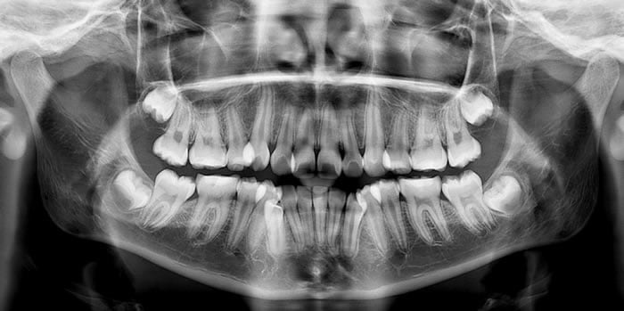 Radiografía dental - Clínica Dental en Valencia Benimaclet ARTDENTA
