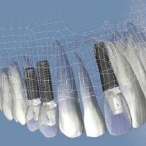 implante3d