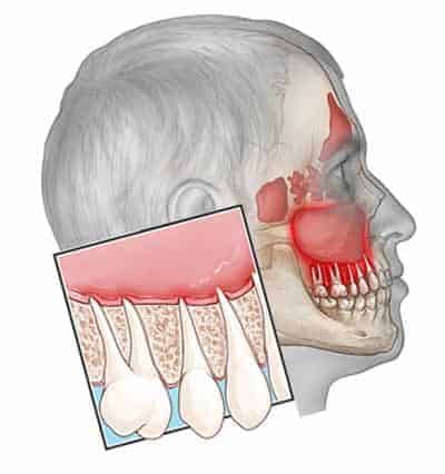 Causas del dolor de Muelas en Artdental Valencia