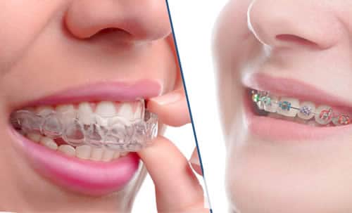 Ortodoncia Invisalign frente a Brackets en Valencia