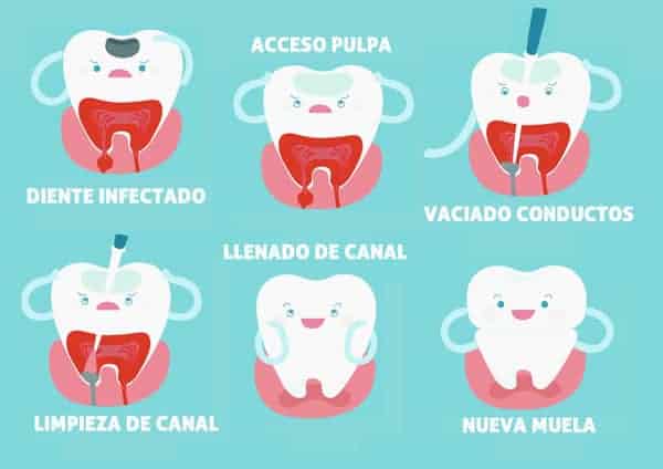 Fases del tratamiento de Endodoncia - Clínica Dental en Valencia Benimaclet 