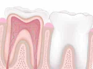 Que significa Endodoncia - Clínica Dental en Valencia Benimaclet ARTDENTA
