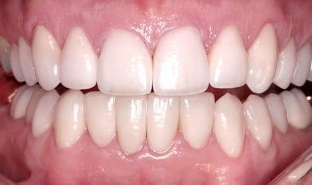 Dientes Pulidos - Clínica dental Artdenta