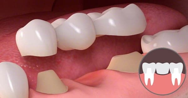 Puente Dental en Clínica Dental Artdenta en Benimaclet (Valencia)