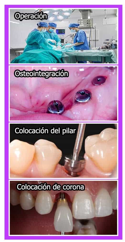 Operatorio implantes dentales