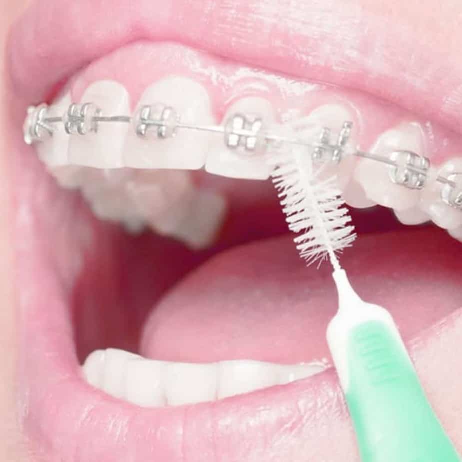 Brackets autoligables, ¿Qué son? Clínica Dental en VALENCIA Benimaclet