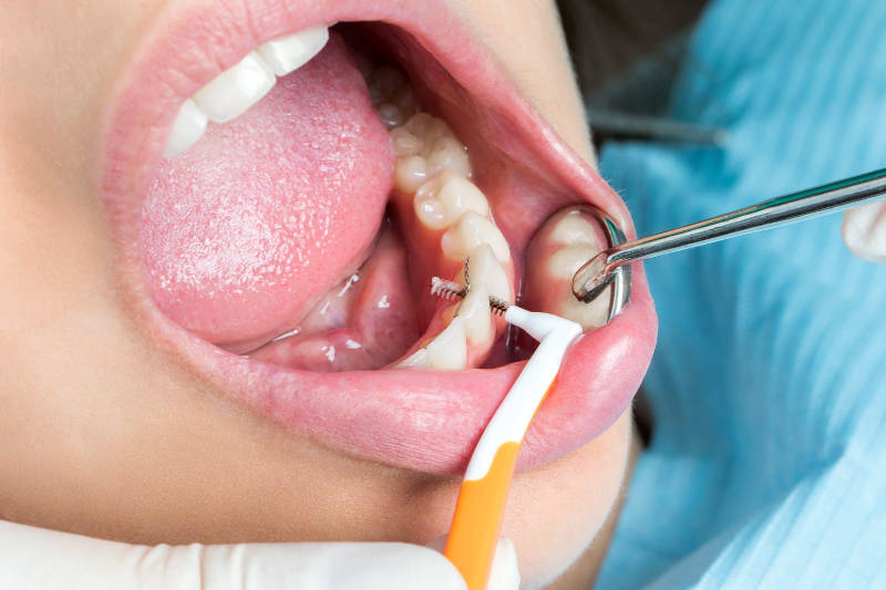 Limpeiza profesional con cepillo interdental | Clínica Dental Artdenta Valencia