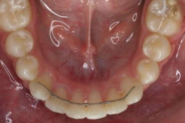 retenedores tratamiento ortodoncia