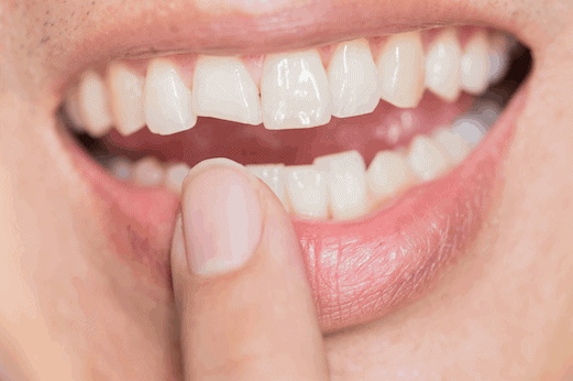 Traumatismo dental