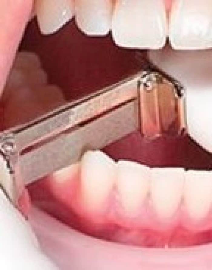 ¿Qué es un stripping dental? Clínica Dental en VALENCIA Benimaclet