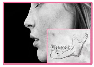 Tamaño de hueso para implantes