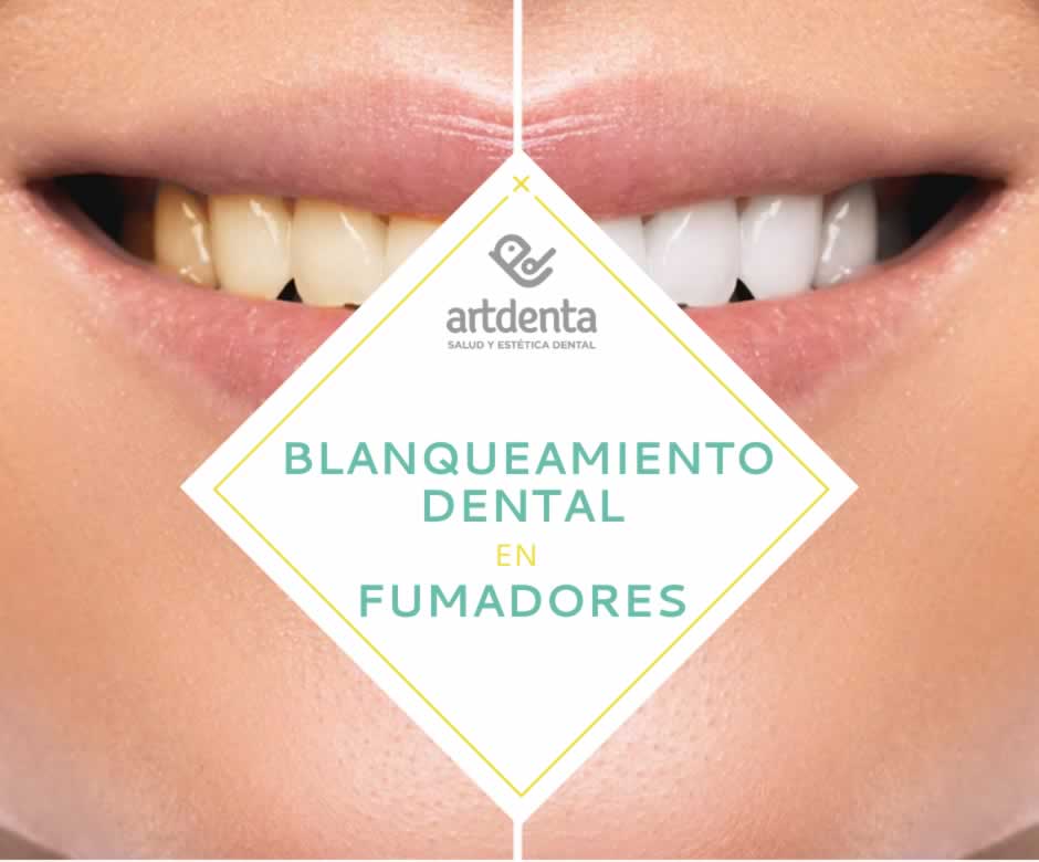 El blanqueamiento dental en fumadores || Clínica dental Artdenta Valencia