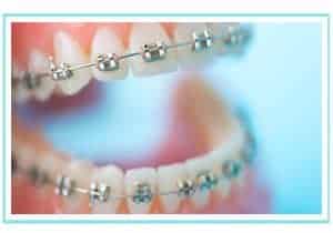10 mitos sobre ortodoncia
