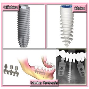 Diseño de implantes