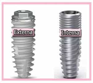 Implantes según su conexión
