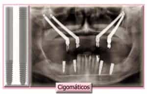 Implantes Cigomáticos