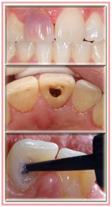 Blanqueamiento dental interno