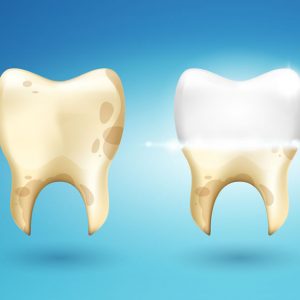 Tipos de blanqueamiento en fumadores | Clínica Dental Artdenta en Valencia