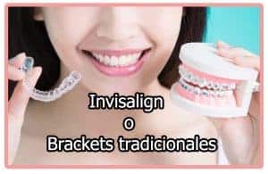 Invisalign o brackets
