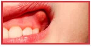 Endodoncia con inflamación