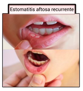 Estomatitis aftosa recurrente