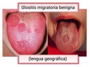 Glositis Migratoria Benigna