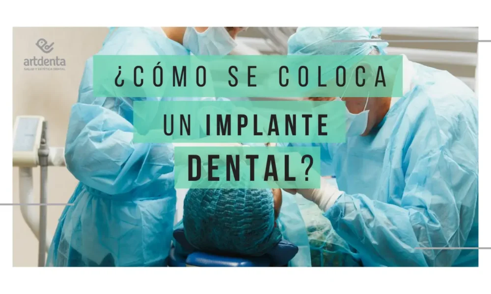 Banner como se coloca un Implante dental | Clínica Dental Artdenta Valencia