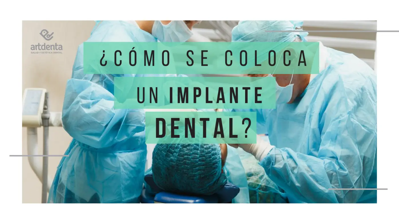 Banner como se coloca un Implante dental | Cl&iacute;nica Dental Artdenta Valencia