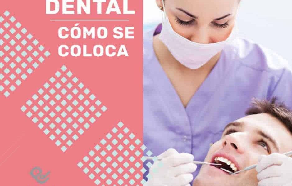 Cómo colocar Implantes Dentales | ARTDENTA.ES
