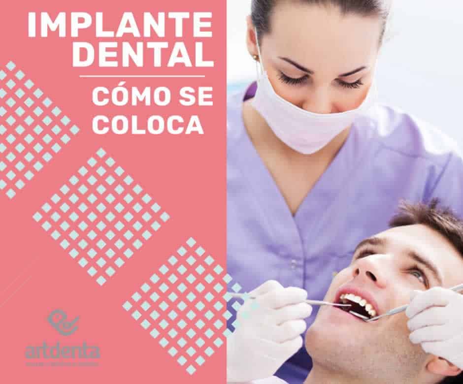 Cómo colocar Implantes Dentales | ARTDENTA.ES