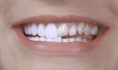 Tipos de Carillas Lumineers | Clínica dental en Valencia | Artdenta