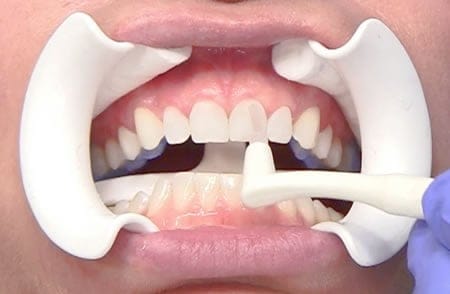 Como se ponene las Carilas Lumineers | Clínica dental en Valencia Artdenta