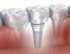 Implantes dentales y encías en Encías Sangrantes | Clínica dental en Valencia | Artdenta