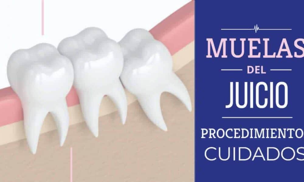 Banner todo sobre las Muelas del Juicio