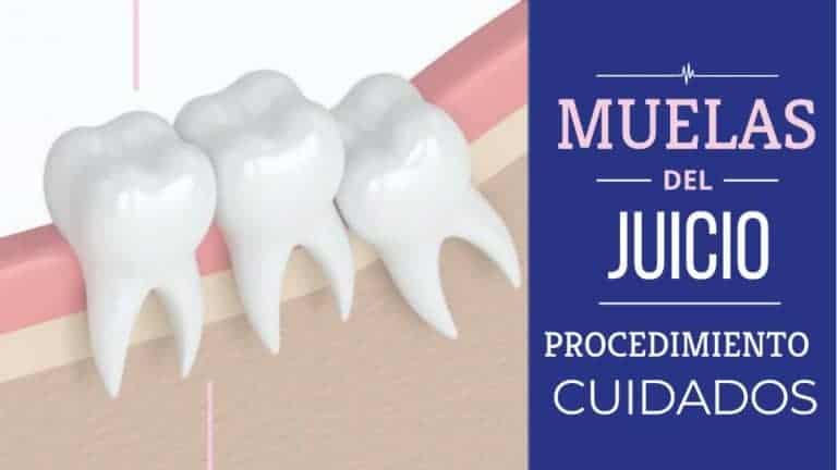 Todo Sobre La Extración De Las Muelas Del Juicio Clínica Dental En Valencia Benimaclet 9769