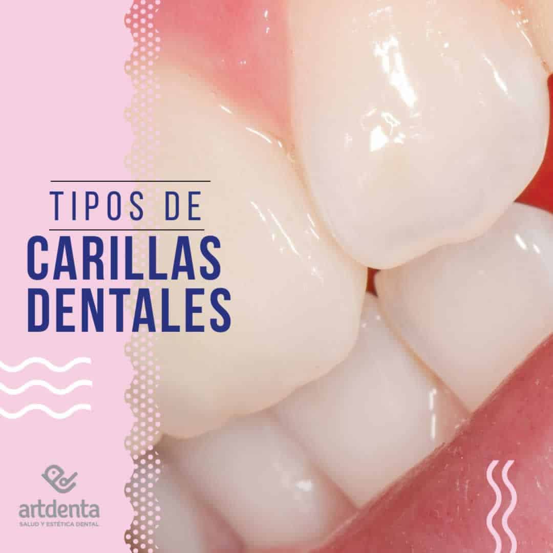Tipos - Clases de carillas dentales | Clínica dental en Valencia Artdenta
