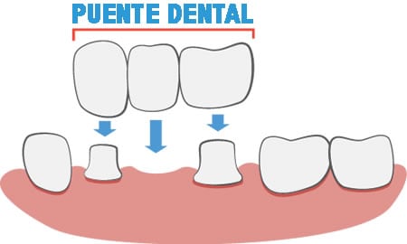 Esquema Puente Dental | Clínica Dental en Valencia ARTDENTA